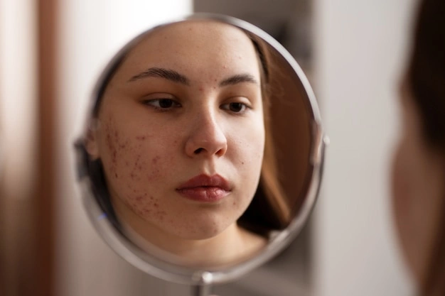 Understanding Your Oily Acne-Prone Skin
